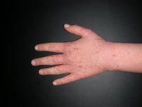 Proteinkontaktdermatitis