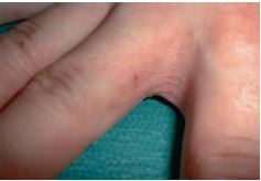 Abb. 2: Hautveränderungen mit Rötung, Schuppung und Einrissen im Fingerzwischenraum