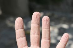 Abb. 3: Durch Feuchtigkeit faltig aufgequollene Haut an den Fingern (Waschfrauenhände)