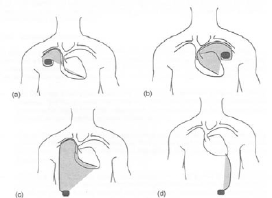 Implantationstechniken